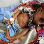 At least 630,000 under-five Yemeni children suffering from acute malnutrition