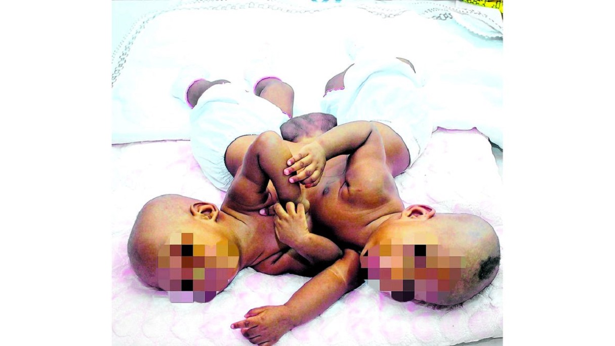 Pacha walioungana kifuani kufanyiwa upasuaji leo.