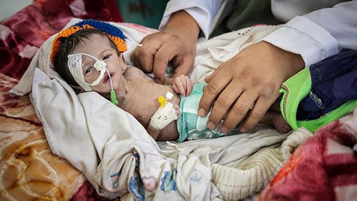 Zaidi ya watoto wachanga 80 wanafariki kila siku mara baada ya kuzaliwa nchini Yemen